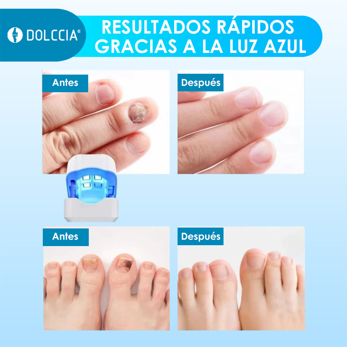 CuraLáser para Uñas Sanas - Viral TikTok