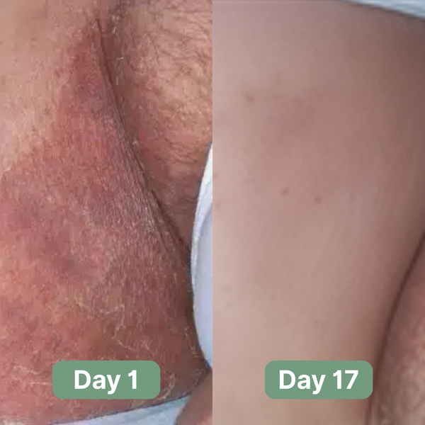 Jabón Anti-tiña inguinal